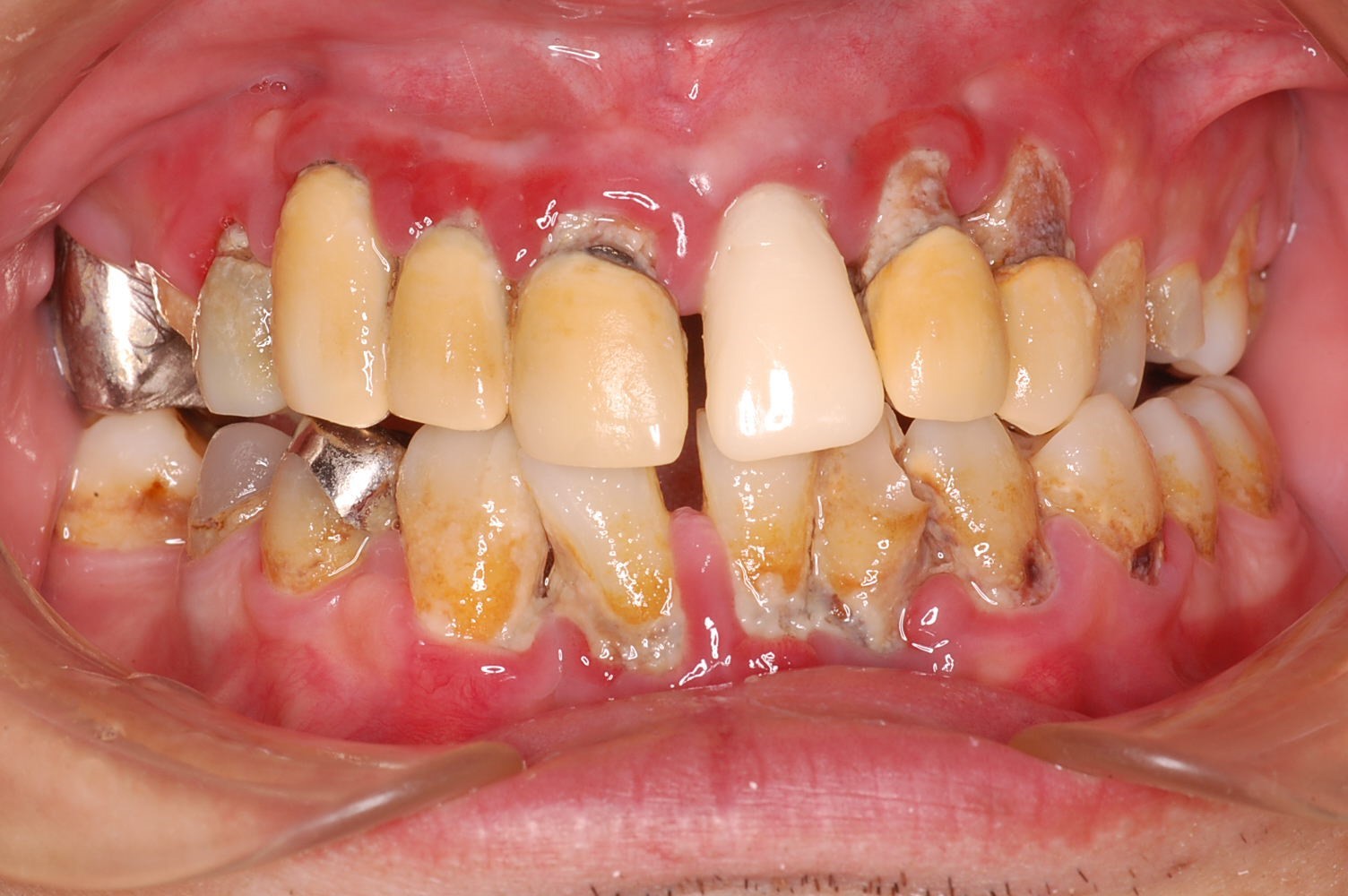 歯茎 の 潰瘍