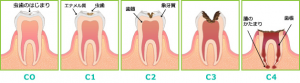 虫歯の進み方のイラスト