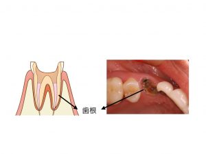 歯の根の図と写真
