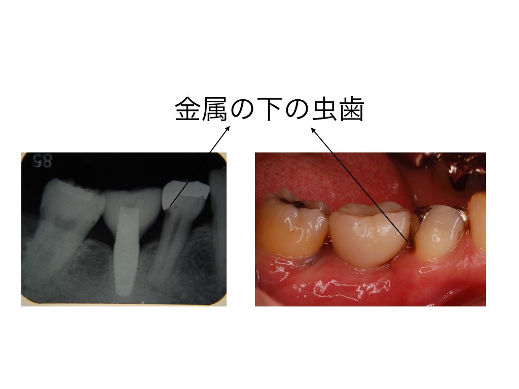 レントゲンでわかる虫歯とわからない虫歯の違いとは