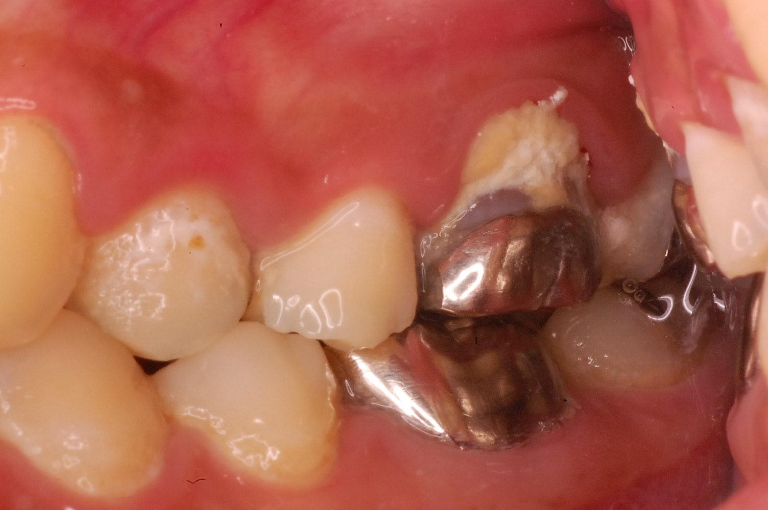 歯石大臼歯