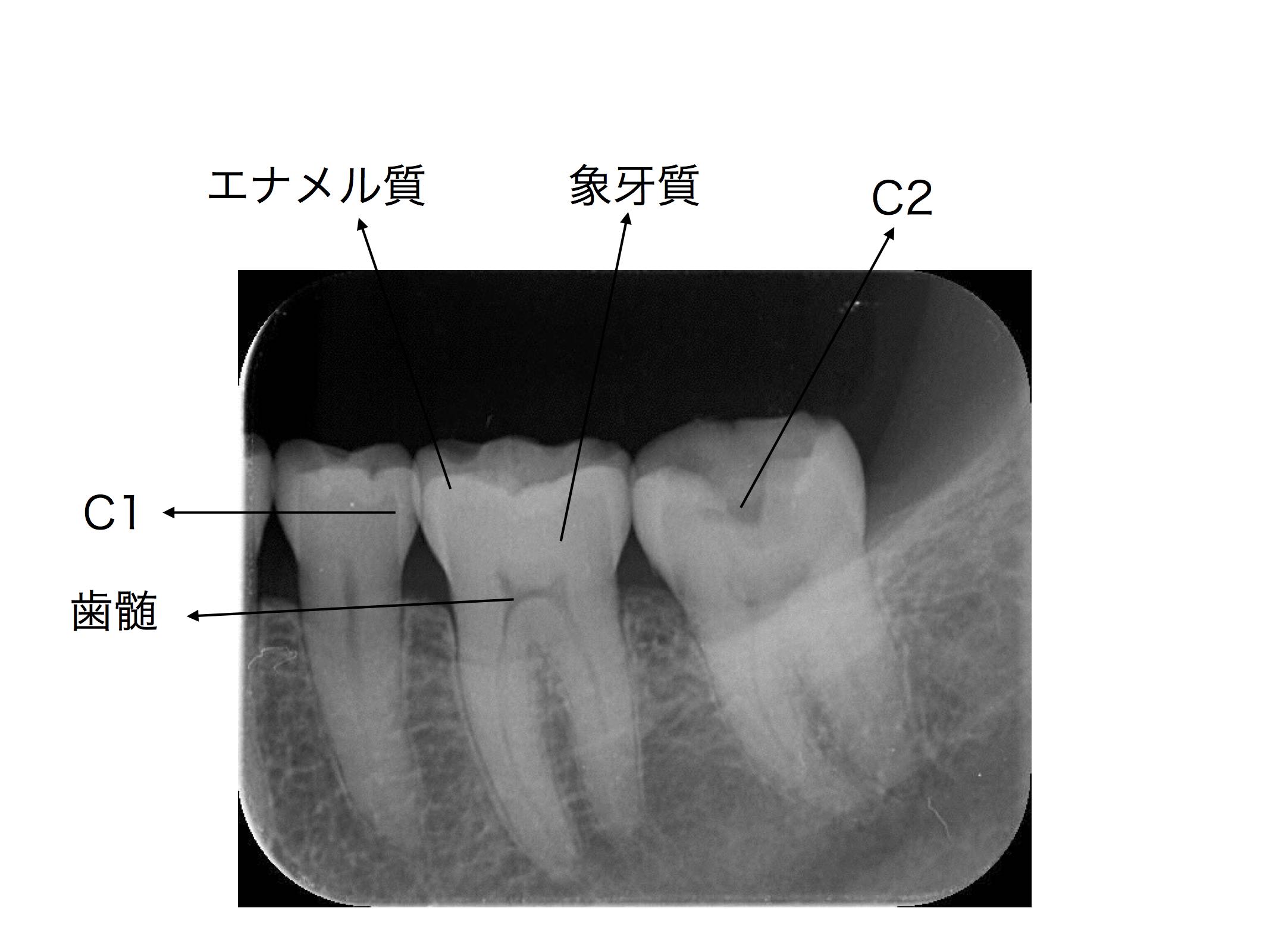 レントゲンでわかる虫歯とわからない虫歯の違いとは