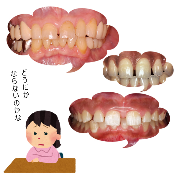 画像で分かりやすく解説 すきっ歯の矯正方法