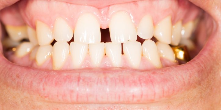 画像で分かりやすく解説 すきっ歯の矯正方法