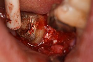歯周外科　再生療法