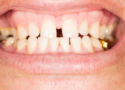 すきっ歯、正中離開、空隙歯列の画像