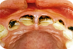 大人とは違う 子供の虫歯の６つの特徴と治療法