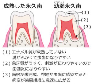 幼弱永久歯の特徴