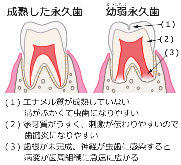 幼若永久歯の特徴