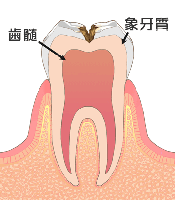 C2の虫歯