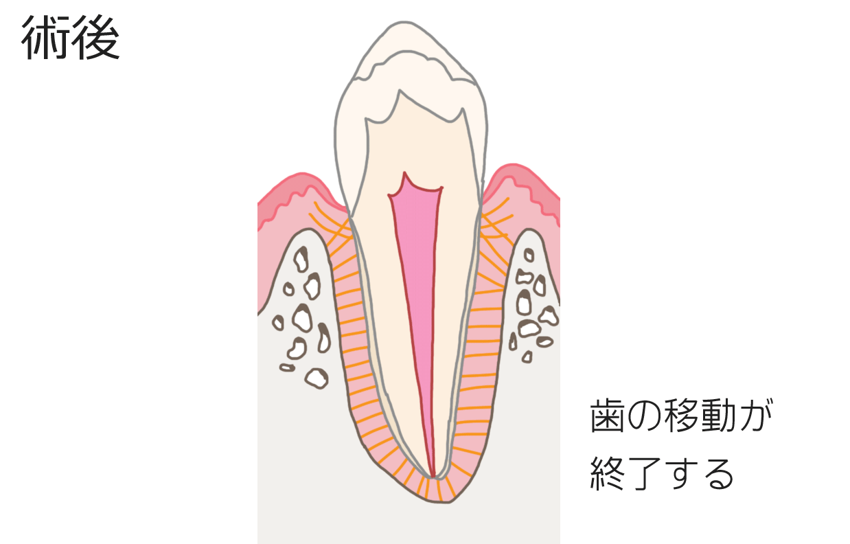 矯正での歯の動き方