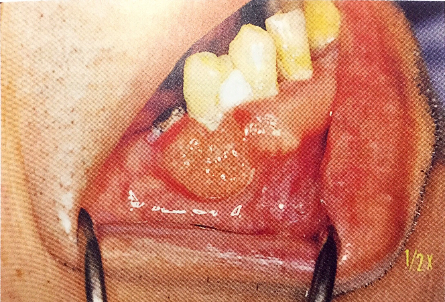 歯肉癌