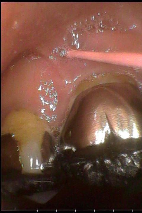 歯ぐきの腫れ
