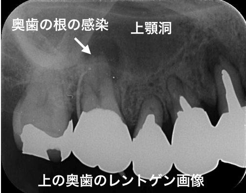 歯性上顎洞炎レントゲン