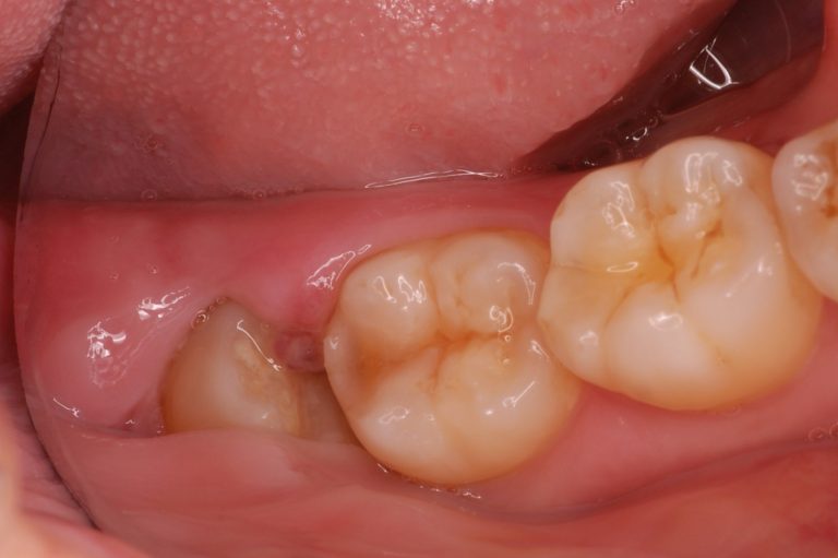 噛み 合わせ 歯茎 の 腫れ