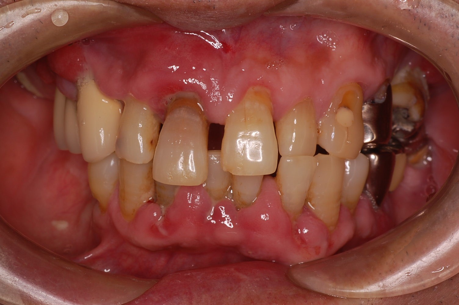 歯周病　歯ぐきの腫れ