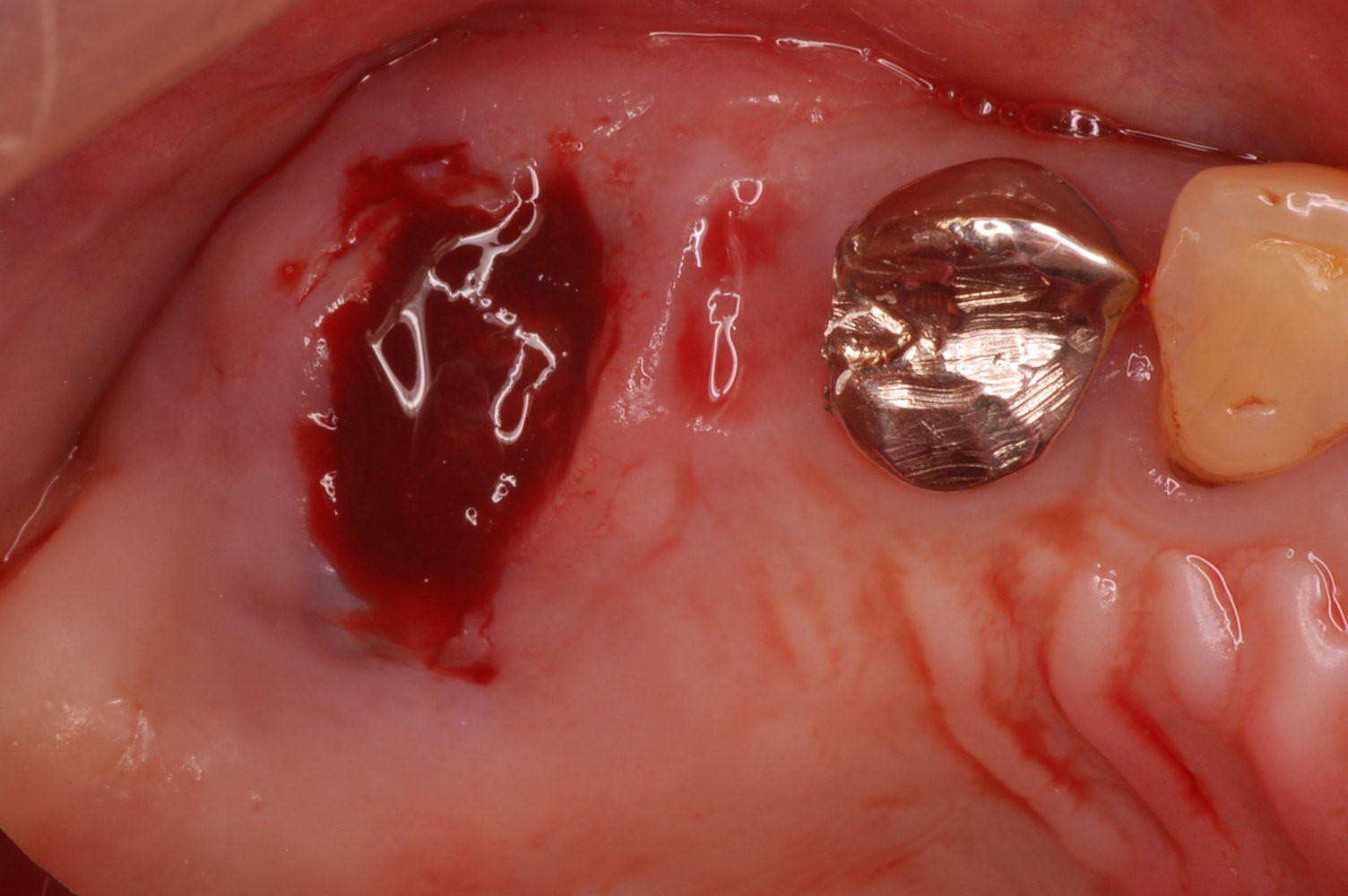 抜歯窩の膿み