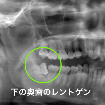 下顎の歯ぐきの腫れレントゲン