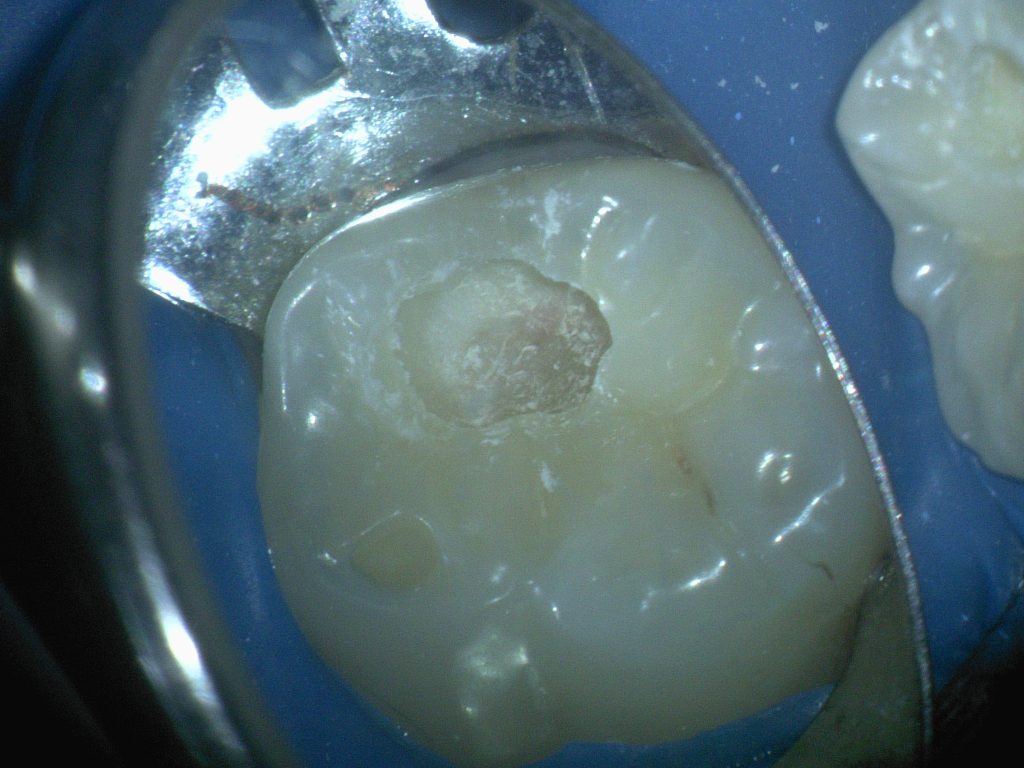 虫歯の形