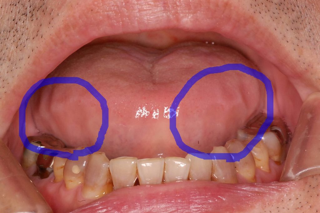歯痕の口腔内写真