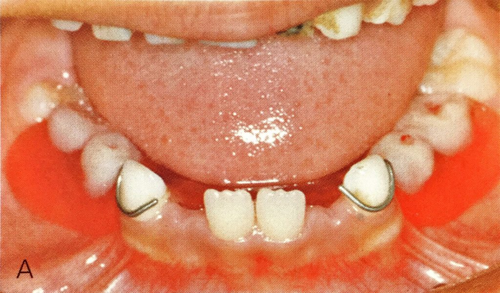 小児義歯