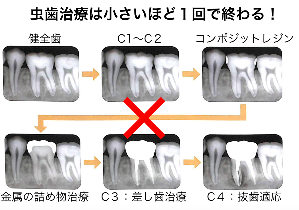 虫歯治療の案循環
