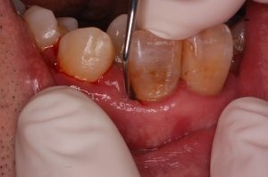 歯周ポケット検査の口腔内写真