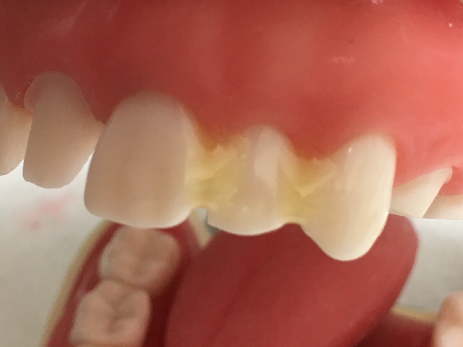 歯の固定