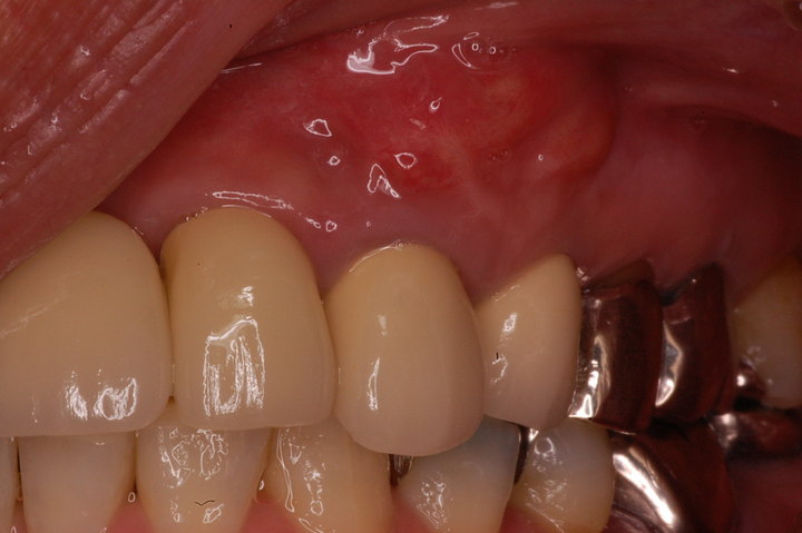 歯根破折による歯肉の腫れ