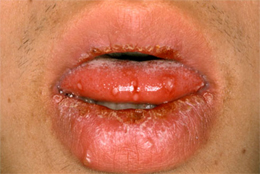ヘルペス性口内炎の口腔内写真