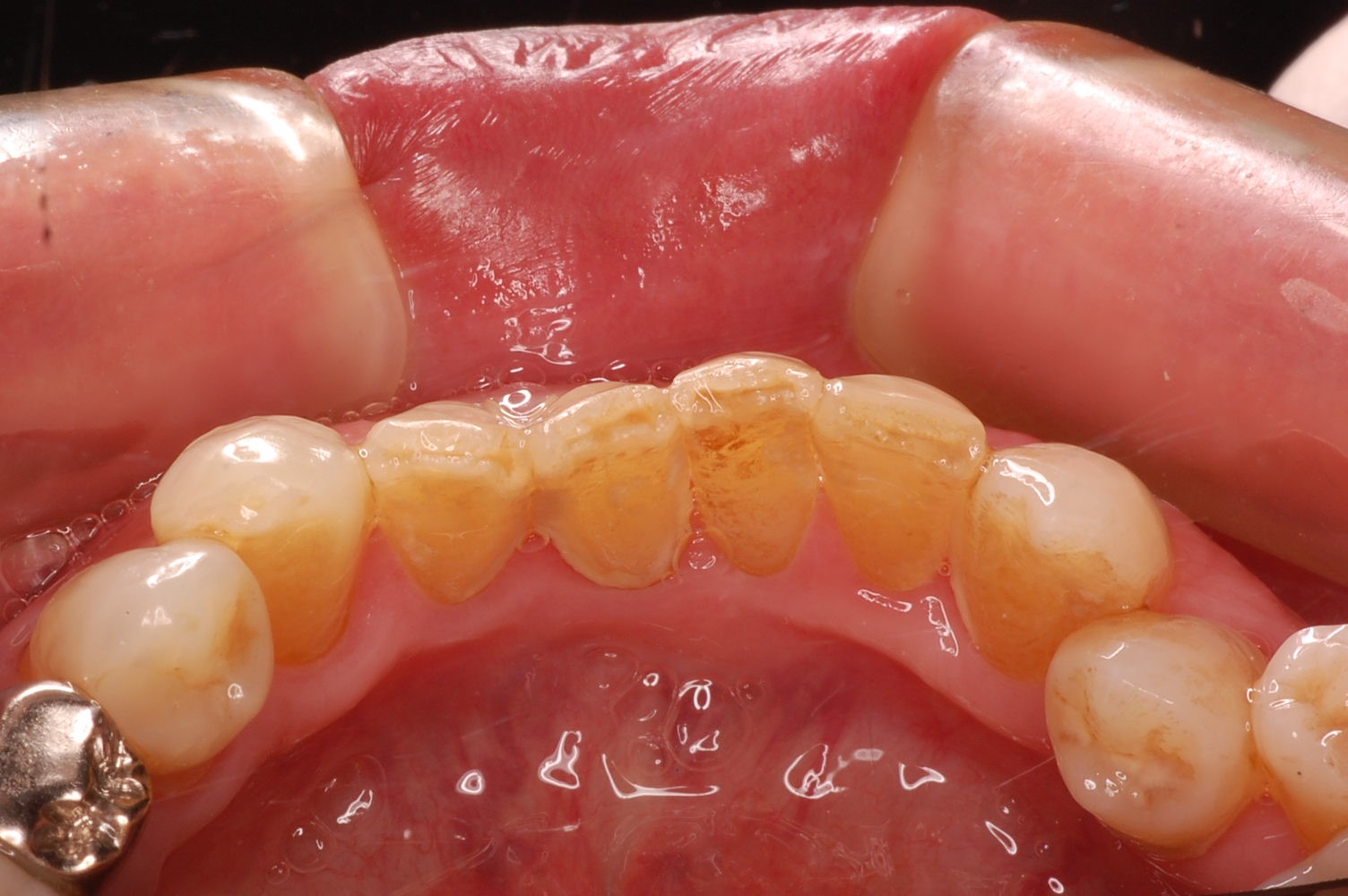 歯石除去前の口腔内写真
