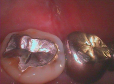 金属の周りの虫歯