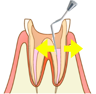 歯根破折の原因の側方加圧