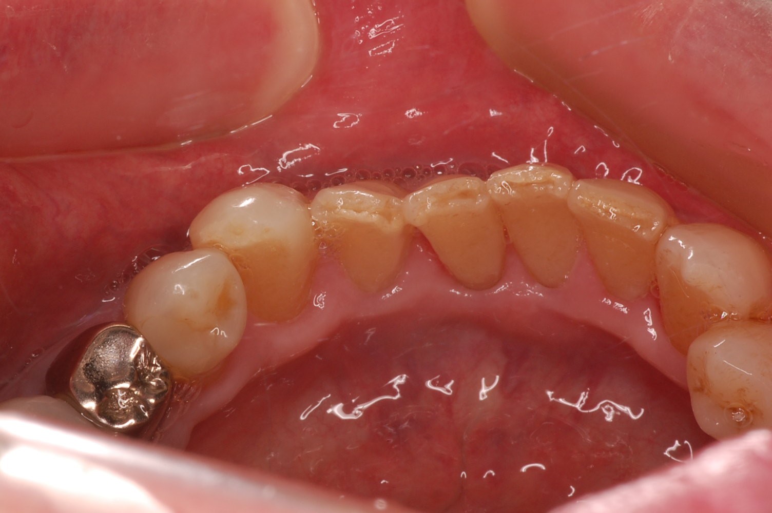 歯石除去後の口腔内写真