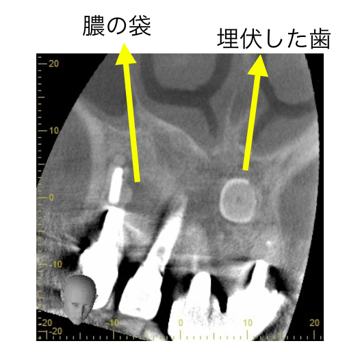 CT埋伏歯