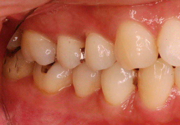 歯周病治療前写真
