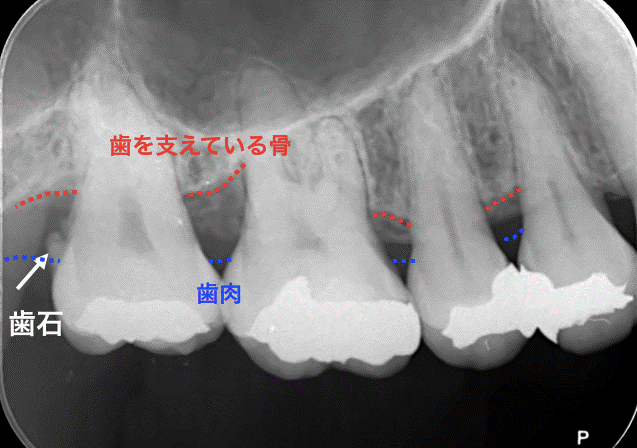 歯周病治療前レントゲン写真