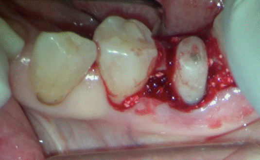 歯周病手術