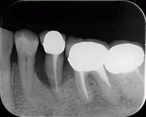 歯周病重度レントゲン写真
