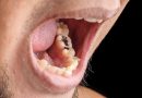 虫歯　銀歯