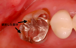 銀歯の周りの歯の破折