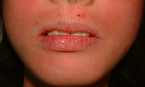 歯科金属アレルギー皮膚症状