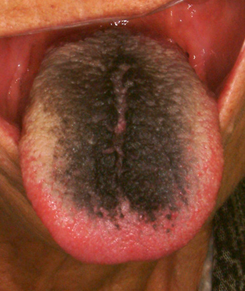 黒毛舌