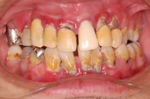 辺縁性歯周炎