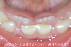 乳歯　永久歯