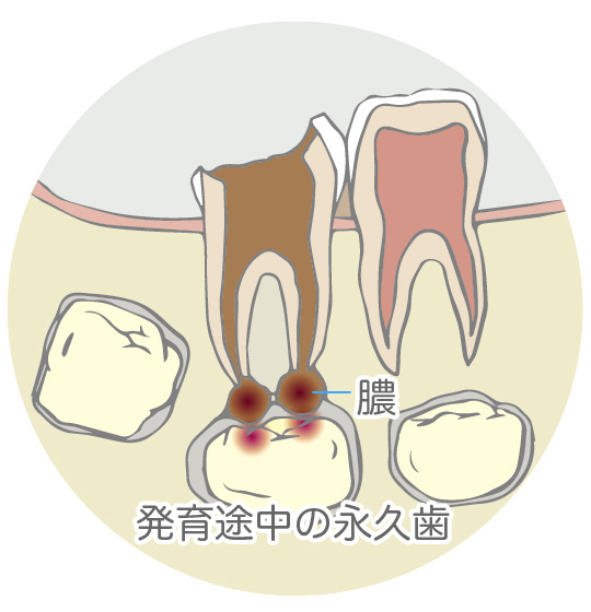 乳歯　虫歯
